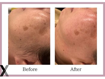 クロス(Xcross)/フェイスワックス【毛穴/渋谷】