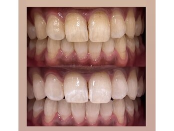 アロハマイネイルアンドアイラッシュ/セルフホワイトニング