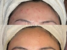 ルオン(Luon.)/たまご肌/ハーブピーリング