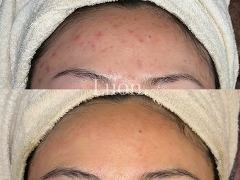 ルオン(Luon.)/たまご肌/ハーブピーリング