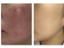 ゾーンビューティーハウス 松戸店(ZONE BEAUTY HOUSE)/美肌、美白肌質改善コース♪