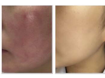 ゾーンビューティーハウス 松戸店(ZONE BEAUTY HOUSE)/美肌、美白肌質改善コース♪