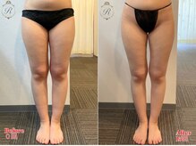 ルフレ(REFLET)/【事例10】Before/After痩身