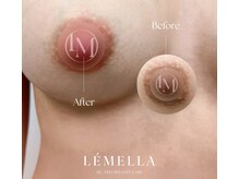 ルメラ/バストトップ・Before/After