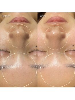 アイビーケア 三田(ivy care)/毛穴洗浄×エクソソームハーブ