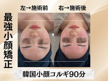 イヨヨ(iyoyo)/【小顔コルギ90分】Before After