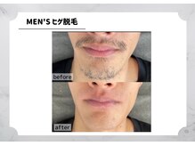 アルゴ 福津店(ALGO)/【メンズ】ヒゲ脱毛