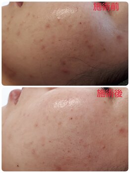 サロンドール(SalonDoll)/陶肌トリートメント