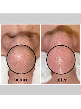 毛穴専科/毛穴ケア人気No1メニュー★
