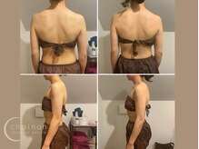 シェノン(chainon)/Before/After 【二の腕＆背中】