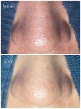 サロン ド ラム/【毛穴改善コース】１回目の効果