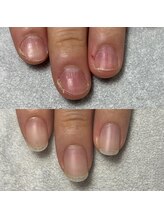 トレフル(Trefle)/深爪矯正継続コース