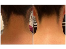 エステサロン ジジ 新宿(JIJI)/ソフトシェービング例３（襟足）