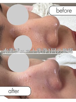 ナチュラル グロウ 木更津(NATURAL GLOW)/水素毛穴洗浄×美容液導入