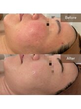 マヴィ(Mavie)/赤ら顔　Before→After