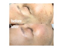 サンティエ(Santie)/長年の悩みのシミケア