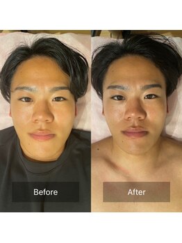 サンサンゴビューティー(335beauty)/リブセラ/施術回数1回