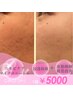 【ニキビケアマイクロニードル60分】強力殺菌＆皮脂抑制　￥5000
