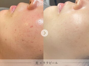 スパレーカ(Spa laka)/赤み・ニキ◯跡ケア