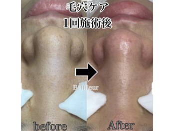 ベルフルール 浜松中野町店/毛穴エクストラクション