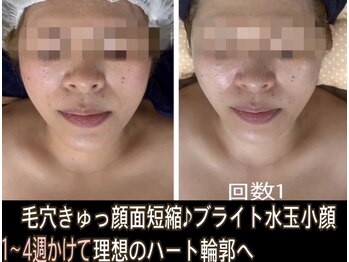 アルページュ(Arpege)の写真/韓国人気★エステ版チタニウムリフト【小顔輪郭×高ハリ×色白シミケア×毛穴レス】一度で叶う欲張り美容