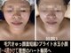 アルページュ(Arpege)の写真/韓国人気★エステ版チタニウムリフト【小顔輪郭×高ハリ×色白シミケア×毛穴レス】一度で叶う欲張り美容