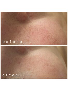 メナードフェイシャルサロン 岐阜茜部/肌荒れ//乾燥/脂性肌