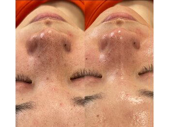 アイアール(ir)/ハイドラアクア