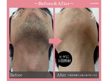 アリュール(Allure)/ひげ脱毛