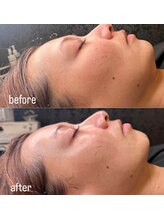 ココリッチ(KoKoRichi)/【レモンボトル】３回顎下