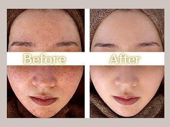 ハル(HARU.)/ハーブピーリング