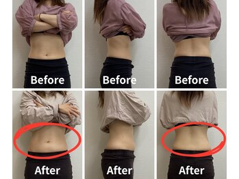 Noa接骨院 はりきゅう院/脂肪冷却 B/A写真