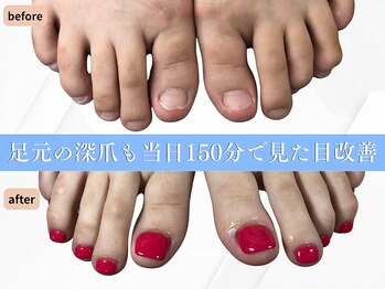 ブルームーンネイルズ(BLOOMOON.nails)の写真/【フットの深爪のお悩みに】その日のうちに見た目の変化を実感◎サンダルも楽しめる足元へ