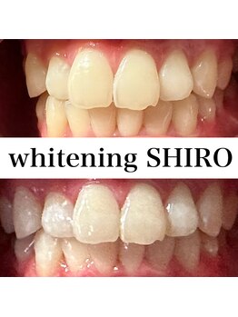 福岡ホワイトニングシロ 天神中洲店(福岡ホワイトニングSHIRO)/【ホワイトニング】before/after