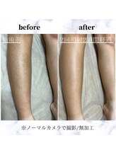 エルアンドエル(L&L)/驚くほどの脱毛効果！