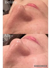 ウォーム(Warm)/30代女性毛穴エクストラクション