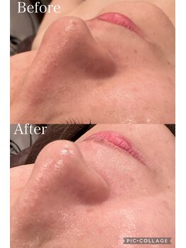 ウォーム(Warm)/30代女性毛穴エクストラクション