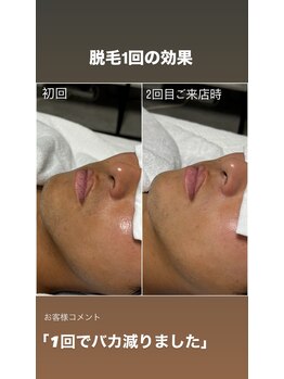 ルシャトン(Le Chaton)/ヒゲ脱毛