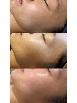 ナトゥーラ(NatuLa)/オールハンドフェイシャル