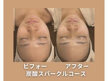 アオイスター(AOIstar)/炭酸スパークル