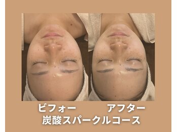 アオイスター(AOIstar)/炭酸スパークル