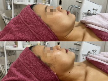 GRACETHOUSAND(グレイスサウザンド)/ハーブピーリング/小顔/たるみ