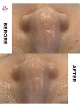 ムム(mumu)/ハーブピーリングで毛穴ケア