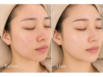 リン 大村本店(Rin)の写真/《フェイシャル/脱毛は当店にお任せ◎》リピータさん多数!スタッフこだわりのフェイシャルをお試し下さい♪