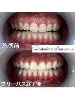 ホワイトニングサロン 京都烏丸店/ホワイトニング施術例