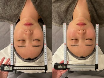 R-1ビューティーサロン 銀座/BEFORE&AFTER 1回目