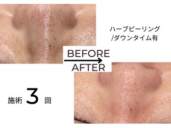 ベガ(Vega)/ハーブピーリングダウンタイム有