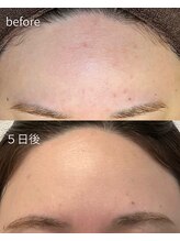 ソルニコン(Solnikon)/2025年誕生　最新！陶肌ピール