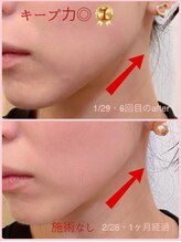 ミレボ(Me.rebo)/リフトアップ最新機器！