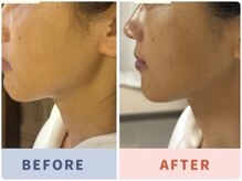 小顔ビフォーアフターくっきりフェイスライン